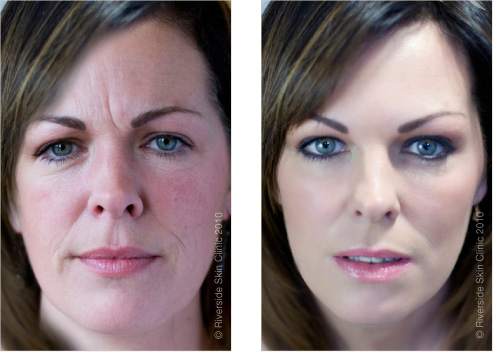 Restylane and Juvederm